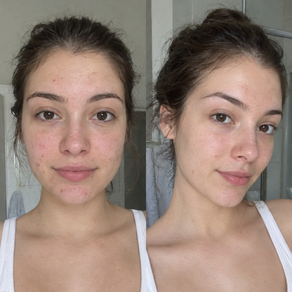 Acne Buster Drying Lotion